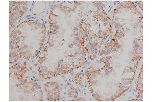 ABIN6267496 at 1/200 staining Human lung cancer tissue sections by IHC-P. (SNCA anticorps  (pSer129))