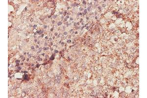 Immunoperoxidase of monoclonal antibody to BGN on formalin-fixed paraffin-embedded human lung, adenosquamous cell carcinoma.