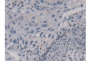 Detection of KIF18A in Human Lung cancer Tissue using Polyclonal Antibody to Kinesin Family, Member 18A (KIF18A)