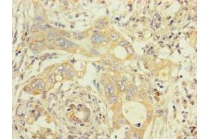 Immunohistochemistry of paraffin-embedded human pancreatic cancer using ABIN7173107 at dilution of 1:100 (TMEM184B anticorps  (AA 311-407))