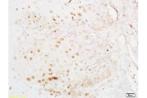 Formalin-fixed and paraffin embedded human esophageal carcinoma labeled with Anti-ELAVL1/HUR Polyclonal Antibody, Unconjugated (ABIN748583) at 1:200 followed by conjugation to the secondary antibody and DAB staining
