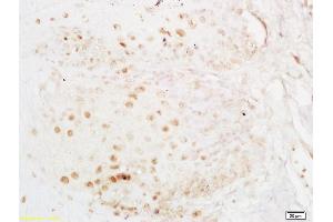 Formalin-fixed and paraffin embedded human esophageal carcinoma labeled with Anti-ELAVL1/HUR Polyclonal Antibody, Unconjugated (ABIN748583) at 1:200 followed by conjugation to the secondary antibody and DAB staining (ELAVL1 anticorps)