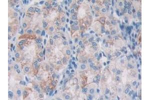 Detection of AGR2 in Human Stomach cancer Tissue using Monoclonal Antibody to Anterior Gradient 2 (AGR2) (AGR2 anticorps  (AA 21-175))