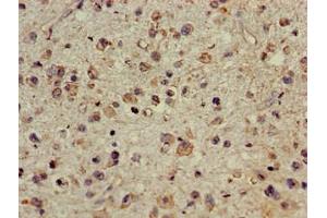 Immunohistochemistry of paraffin-embedded human glioma using ABIN7147710 at dilution of 1:100 (CDYL anticorps  (AA 8-260))