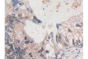 Detection of PLN in Human Colorectal cancer Tissue using Polyclonal Antibody to Phospholamban (PLN)