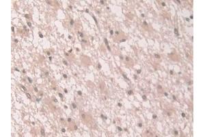 Detection of GCA in Human Glioma Tissue using Polyclonal Antibody to Grancalcin (GCA)