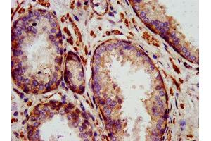 IHC image of ABIN7156872 diluted at 1:1400 and staining in paraffin-embedded human prostate cancer performed on a Leica BondTM system. (IL-24 anticorps  (AA 52-207))