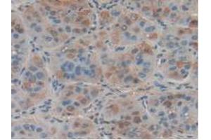 IHC-P analysis of Human Liver Cancer Tissue, with DAB staining. (FASL anticorps  (AA 103-281))