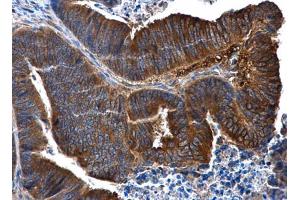 IHC-P Image IL1 Receptor 2 antibody [N3C3] detects IL1 Receptor 2 protein at cytoplasm in human colon cancer by immunohistochemical analysis. (IL1R2 anticorps)