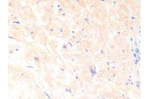 Detection of IL13 in Human Prostate Tissue using Polyclonal Antibody to Interleukin 13 (IL13) (IL-13 anticorps  (AA 25-146))