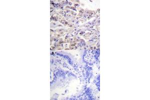 Immunohistochemical staining (Formalin-fixed paraffin-embedded sections) of human lung cancer tissue with HNRNPD (phospho S83) polyclonal antibody  without blocking peptide (A) or preincubated with blocking peptide (B) under 1:50-1:100 dilution. (HNRNPD/AUF1 anticorps  (pSer83))