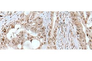 Immunohistochemistry of paraffin-embedded Human colorectal cancer tissue using USP3 Polyclonal Antibody at dilution of 1:50(x200) (USP3 anticorps)