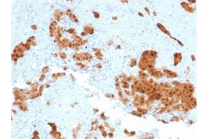 Formalin-fixed, paraffin-embedded human Mesothelioma stained with Calretinin Mouse Monoclonal Antibody (CALB2/2602). (Calretinin anticorps  (AA 23-242))
