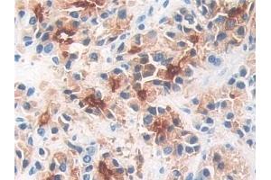 Detection of PMSA in Human Prostate cancer Tissue using Polyclonal Antibody to Prostate-specific Membrane Antigen (PMSA)