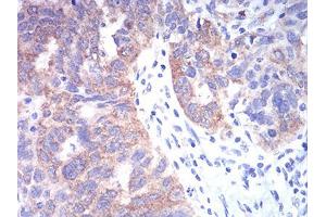 Immunohistochemical analysis of paraffin-embedded ovarian cancer tissues using TBCC mouse mAb with DAB staining.
