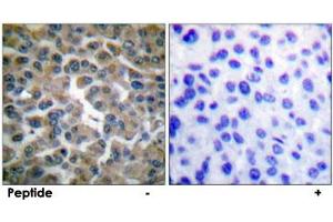 Immunohistochemical analysis of paraffin-embedded human breast carcinoma tissue using NFKBIE polyclonal antibody . (NFKBIE anticorps)