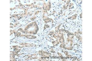 Immunohistochemistry of Human thyroid cancer using ASH2L Polyclonal Antibody at dilution of 1:60 (ASH2L anticorps)