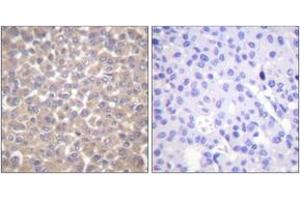 Immunohistochemistry analysis of paraffin-embedded human breast carcinoma tissue, using TRADD Antibody. (TRADD anticorps  (AA 251-300))