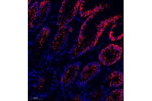 Immunofluorescence of paraffin embedded human colon cancer using MRP1 (ABIN7074544) at dilution of 1:1000 (250x lens) (Multidrug-Resistance Like Protein 1 anticorps)