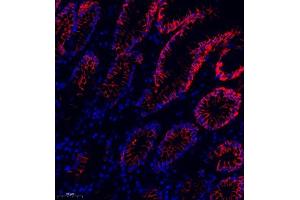 Immunofluorescence of paraffin embedded human colon cancer using MRP1 (ABIN7074544) at dilution of 1:1000 (250x lens) (MRP1 anticorps)