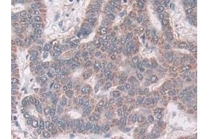 Detection of CXADR in Human Liver cancer Tissue using Polyclonal Antibody to Coxsackie Virus And Adenovirus Receptor (CXADR)