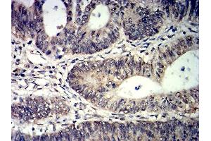 Immunohistochemical analysis of paraffin-embedded rectum cancer tissues using TET2 mouse mAb with DAB staining.