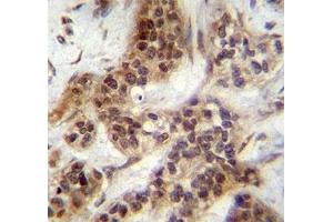 FOXA2 antibody immunohistochemistry analysis in formalin fixed and paraffin embedded human bladder carcinoma.
