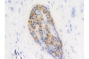 ABIN6256558 and ABIN6267613 at 1/100 staining human pancreatic carcinoma by IHC-P. (PKC zeta anticorps  (pThr410))