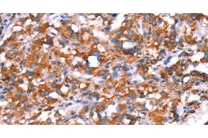 Immunohistochemistry of paraffin-embedded Human thyroid cancer using GH1 Polyclonal Antibody at dilution of 1:40 (Growth Hormone 1 anticorps)