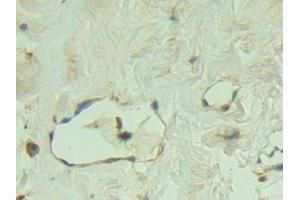 Detection of P-cadherin in Human Breast cancer Tissue using Polyclonal Antibody to Placental Cadherin (P-cadherin)