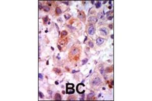 Formalin-fixed and paraffin-embedded human cancer tissue reacted with the primary antibody, which was peroxidase-conjugated to the secondary antibody, followed by AEC staining.