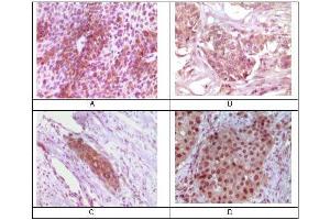 Immunohistochemical analysis of paraffin-embedded human bladder carcinoma (A), breast carcinoma (B), esophagus carcinoma (C), skin carcinoma (D) tissue, showing cytoplasmic localization using Rab25 mouse mAb with DAB staining. (RAB25 anticorps)