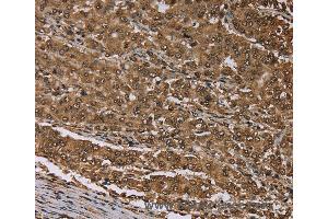 Immunohistochemistry of Human thyroid cancer using MEIS1 Polyclonal Antibody at dilution of 1:30 (MEIS1 anticorps)
