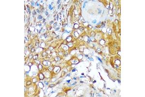 Immunohistochemistry of paraffin-embedded human esophageal cancer using Versican Rabbit mAb (ABIN7271309) at dilution of 1:100 (40x lens).