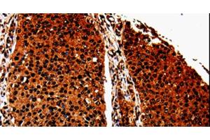 Immunohistochemistry of paraffin-embedded Human renal cancer tissue using ANXA7 Polyclonal Antibody at dilution 1:40 (Annexin VII anticorps)