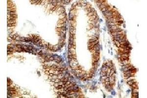 Formalin-fixed, paraffin-embedded human colon carcinoma stained with E-Cadherin antibody (CDH1/1525).