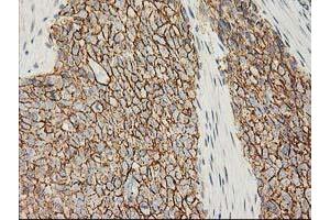 Immunohistochemical staining of paraffin-embedded Adenocarcinoma of Human breast tissue using anti-CTNNB1 mouse monoclonal antibody. (CTNNB1 anticorps)