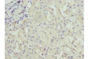 Immunohistochemistry of paraffin-embedded human liver cancer using ABIN7146036 at dilution of 1:100