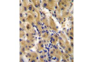 EN Antibody (Center ) C immunohistochemistry analysis in formalin fixed and paraffin embedded human hepatocarcinoma followed by peroxidase conjugation of the secondary antibody and DAB staining. (ENPP2 anticorps  (AA 401-430))