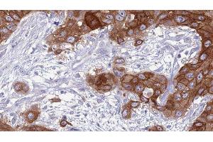 ABIN6277037 at 1/100 staining Human Head and neck cancer tissue by IHC-P. (CD83 anticorps  (Internal Region))
