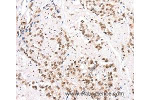 Immunohistochemistry of Human prostate cancer using CTBP2 Polyclonal Antibody at dilution of 1:40 (CTBP2 anticorps)