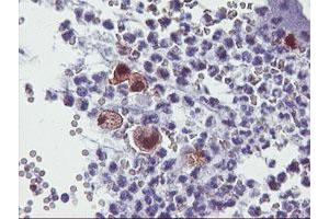 Immunohistochemical staining of paraffin-embedded Adenocarcinoma of Human colon tissue using anti-SDS mouse monoclonal antibody. (serine Dehydratase anticorps)