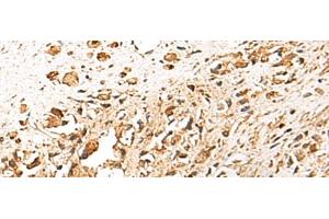 Immunohistochemistry of paraffin-embedded Human prost ate cancer tissue using TERF1 Polyclonal Antibody at dilution of 1:30(x200) (TRF1 anticorps)