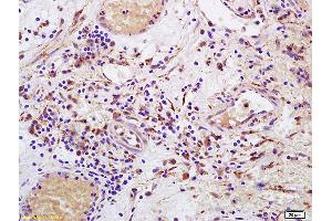 Formalin-fixed and paraffin embedded human bladder carcinoma labeled with Anti-CD158 Polyclonal Antibody, Unconjugated (ABIN748463) at 1:200 followed by conjugation to the secondary antibody and DAB staining. (KIR2DL4/CD158d anticorps  (AA 51-150))
