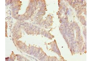 Immunohistochemistry of paraffin-embedded human endometrial cancer using ABIN7166006 at dilution of 1:100