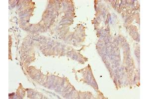Immunohistochemistry of paraffin-embedded human endometrial cancer using ABIN7166006 at dilution of 1:100 (RER1 anticorps  (AA 85-139))