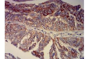 Immunohistochemical analysis of paraffin-embedded ovarian cancer tissues using CD239 mouse mAb with DAB staining. (BCAM anticorps  (AA 32-197))