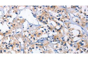 Immunohistochemistry of paraffin-embedded Human thyroid cancer using CAPZA2 Polyclonal Antibody at dilution of 1:30 (CAPZA2 anticorps)