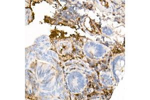 Immunohistochemistry of paraffin-embedded Human colon carcinoma using Human IgG antibody (ABIN7267844) at dilution of 1:300 (40x lens).