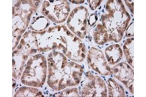 Immunohistochemical staining of paraffin-embedded Carcinoma of liver tissue using anti-NME4 mouse monoclonal antibody. (NME4 anticorps)